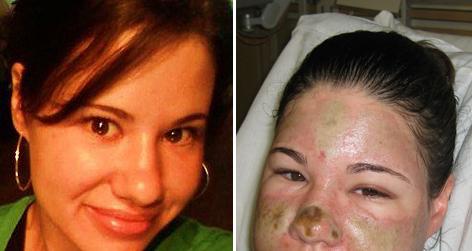 //acid face woman nc