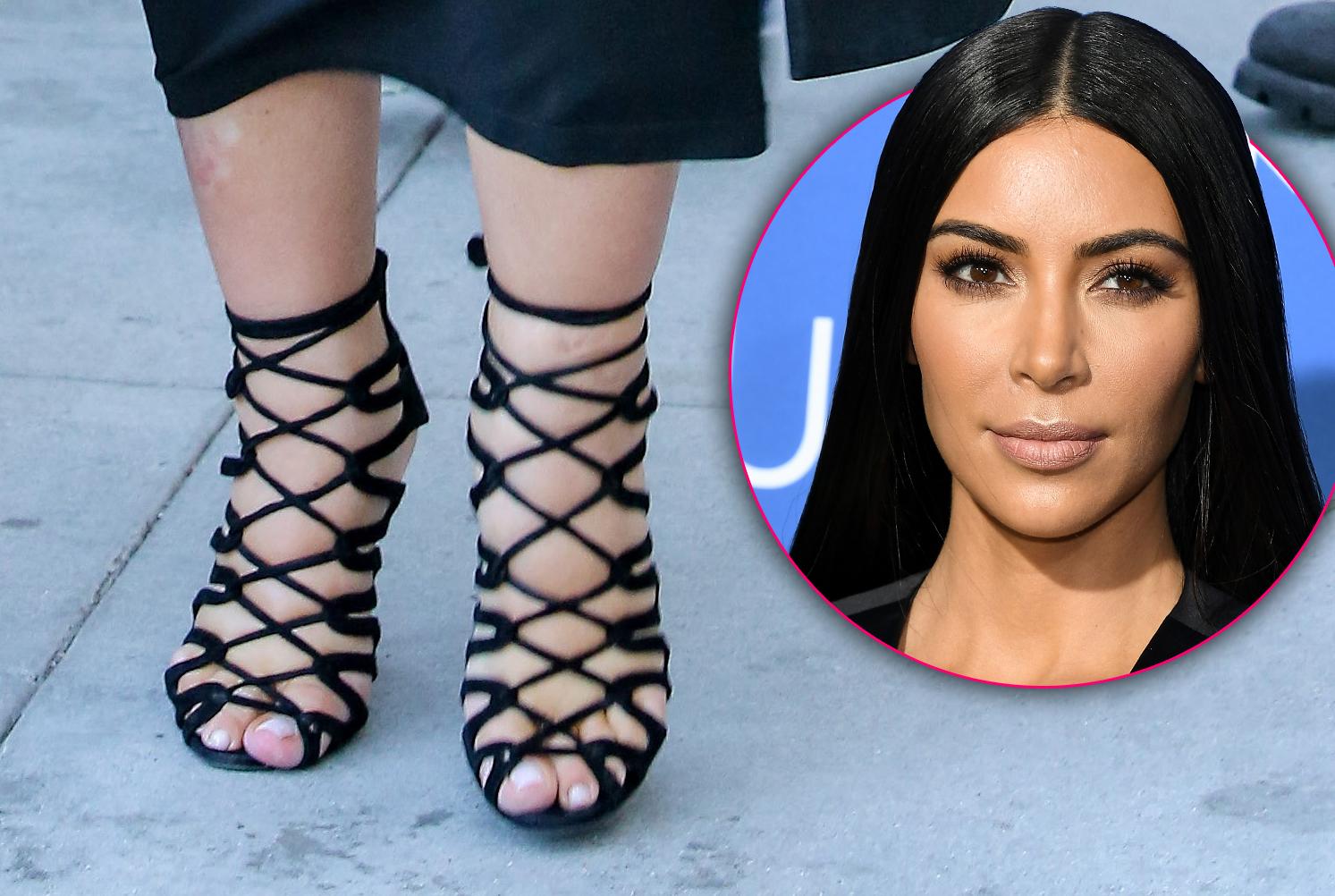 kim kardashian swollen feet cankles hammer toe surgery