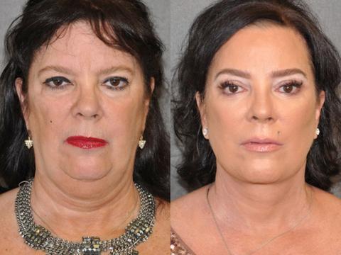 Just Like Kris! Jenner's Sister Goes Under The Knife To Look Like