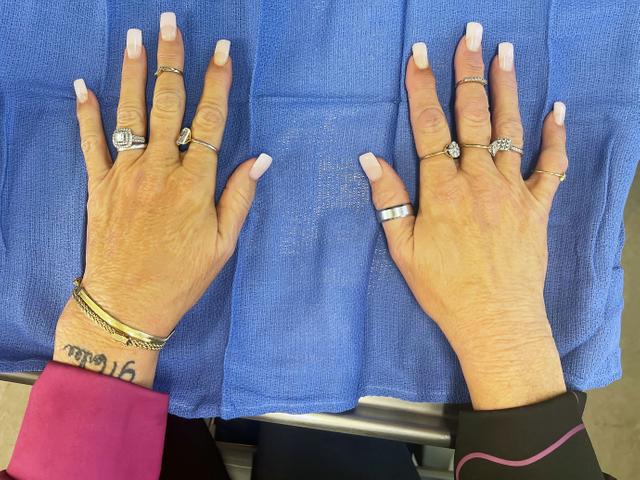 90 Day Fiance Star Angela Deem Undergoes Cosmetic Hand Procedure 