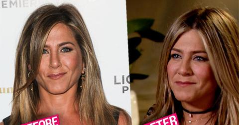//jennifer aniston plastic surgery fillers pp