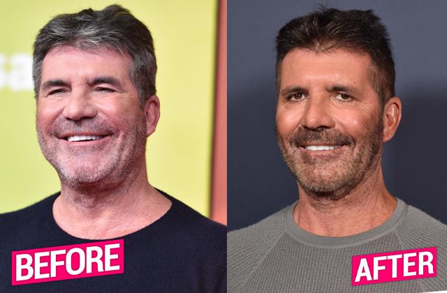 Simon Cowell is done with Botox and fillers in his face