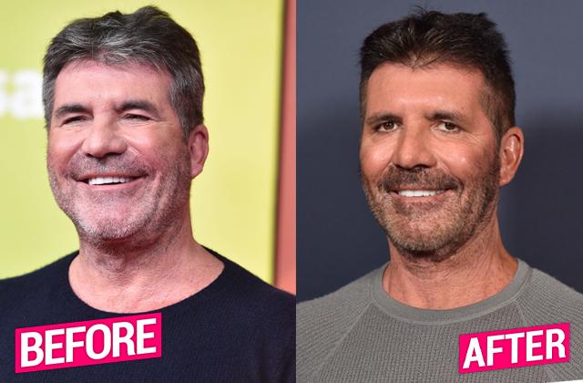 Simon Cowell Plastic Surgery Makeover Exposed By Top Docs