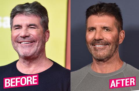 Simon Cowell Plastic Surgery Makeover Exposed By Top Docs