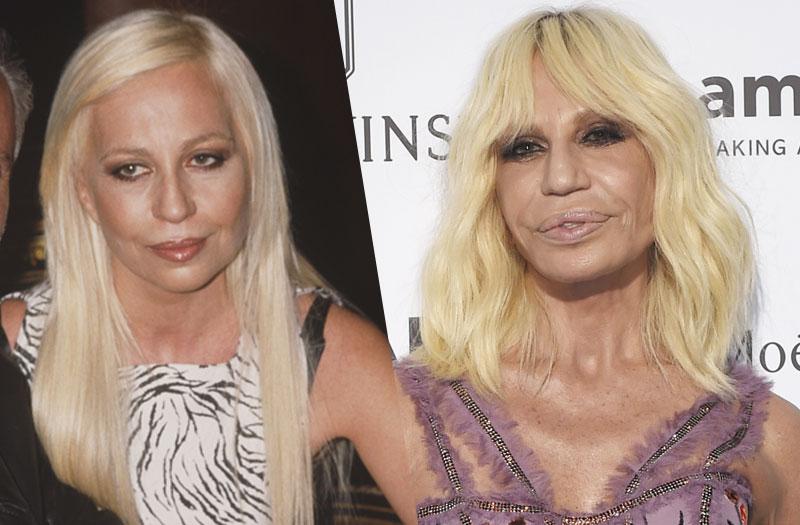 Facelifts Botox Stars With Freaky Faces After Botched Plastic Surgery Procedures