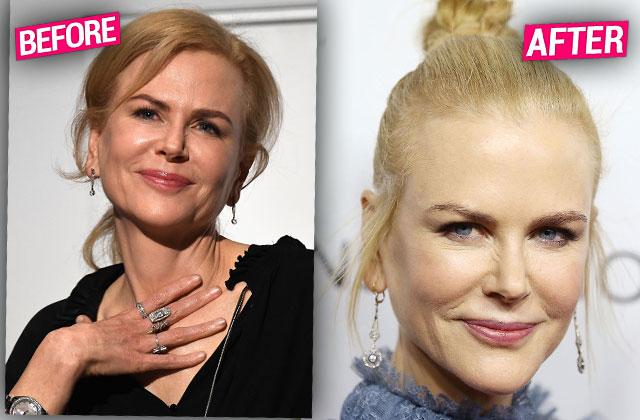 nicole kidman plastic surgeries