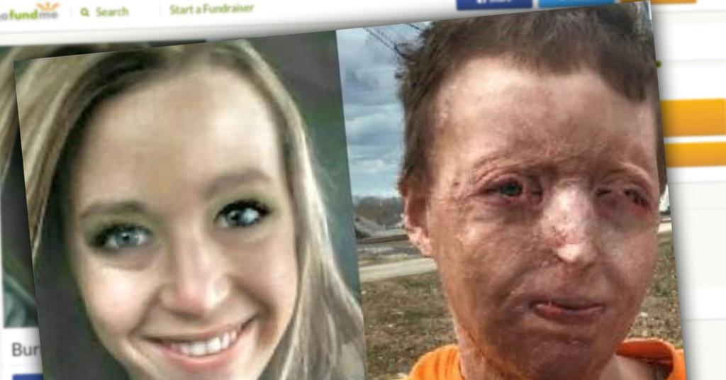 Young Mom Disfigured After Campfire Abandoned By Husband 