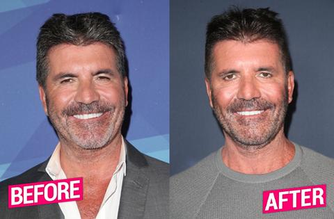 Simon Cowell Plastic Surgery Makeover Exposed By Top Docs