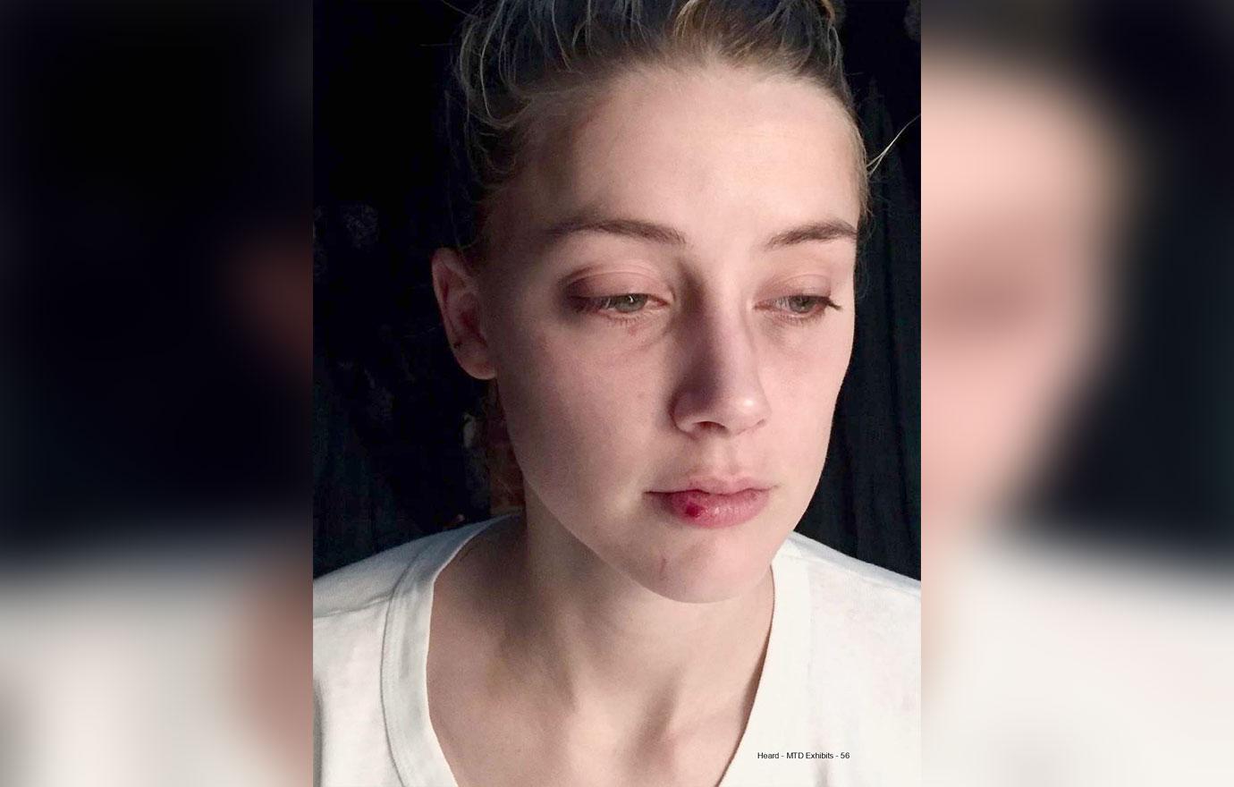 Amber Heard's bruising