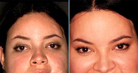 Facial reconstruction