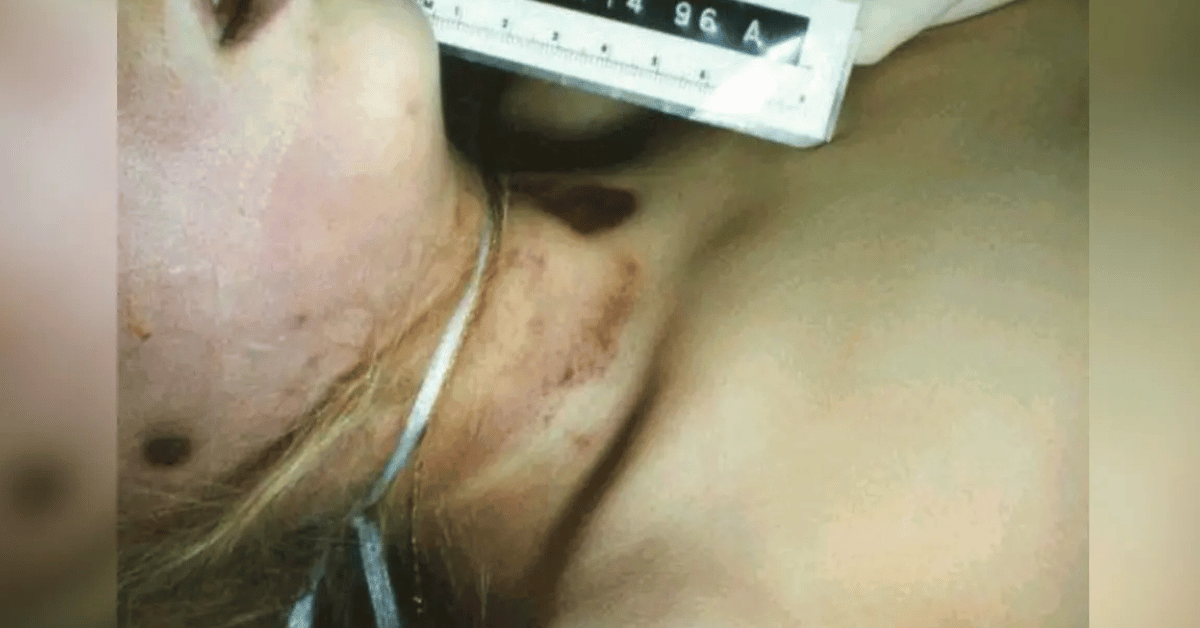 Photo of garrote tied around JonBenét.