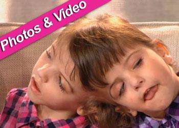 //anderson cooper talk show conjoined twins
