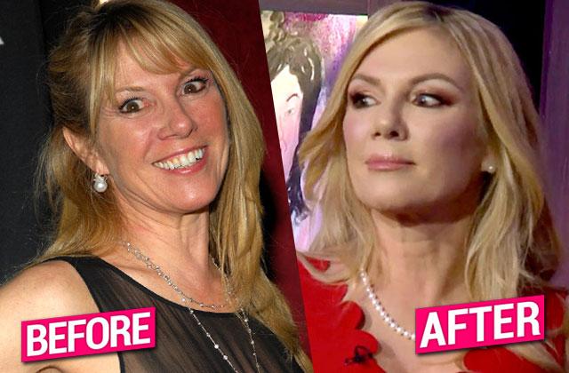 Nip Tuck Time! Top Docs Say Ramona Singer Got A Whole New Face