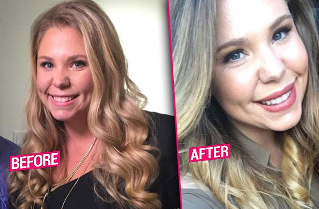 kailyn lowry plastic surgery lip injections