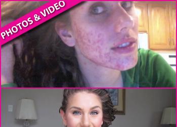 //cassandra bankson acne landov