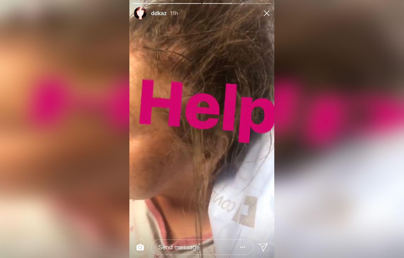 Abby Lee Miller Shows Off Scars, Removes Wig During Cancer: Pics