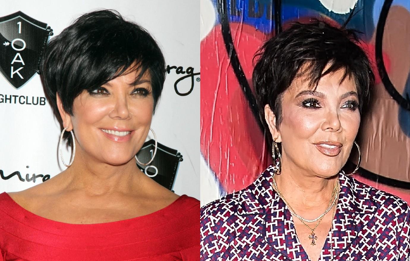 Kris Jenner’s Facial Transformation Sparks Frenzy