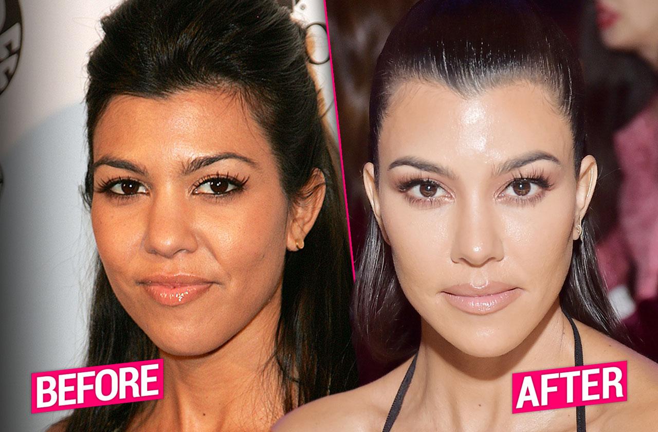 Kourtney Kardashian Plastic Surgery Pp 