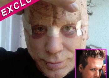 Mickey Rourke's Wrecked Face Is 'A Plethora Of Scars From Several ...