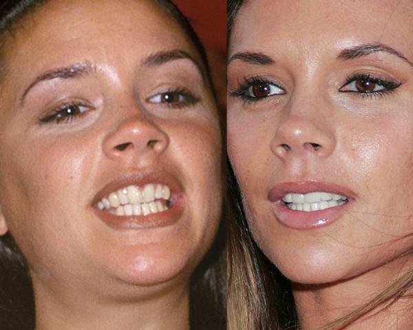 They May Be Beautiful But These Celebs Were Given A Bad Set Of Chompers 