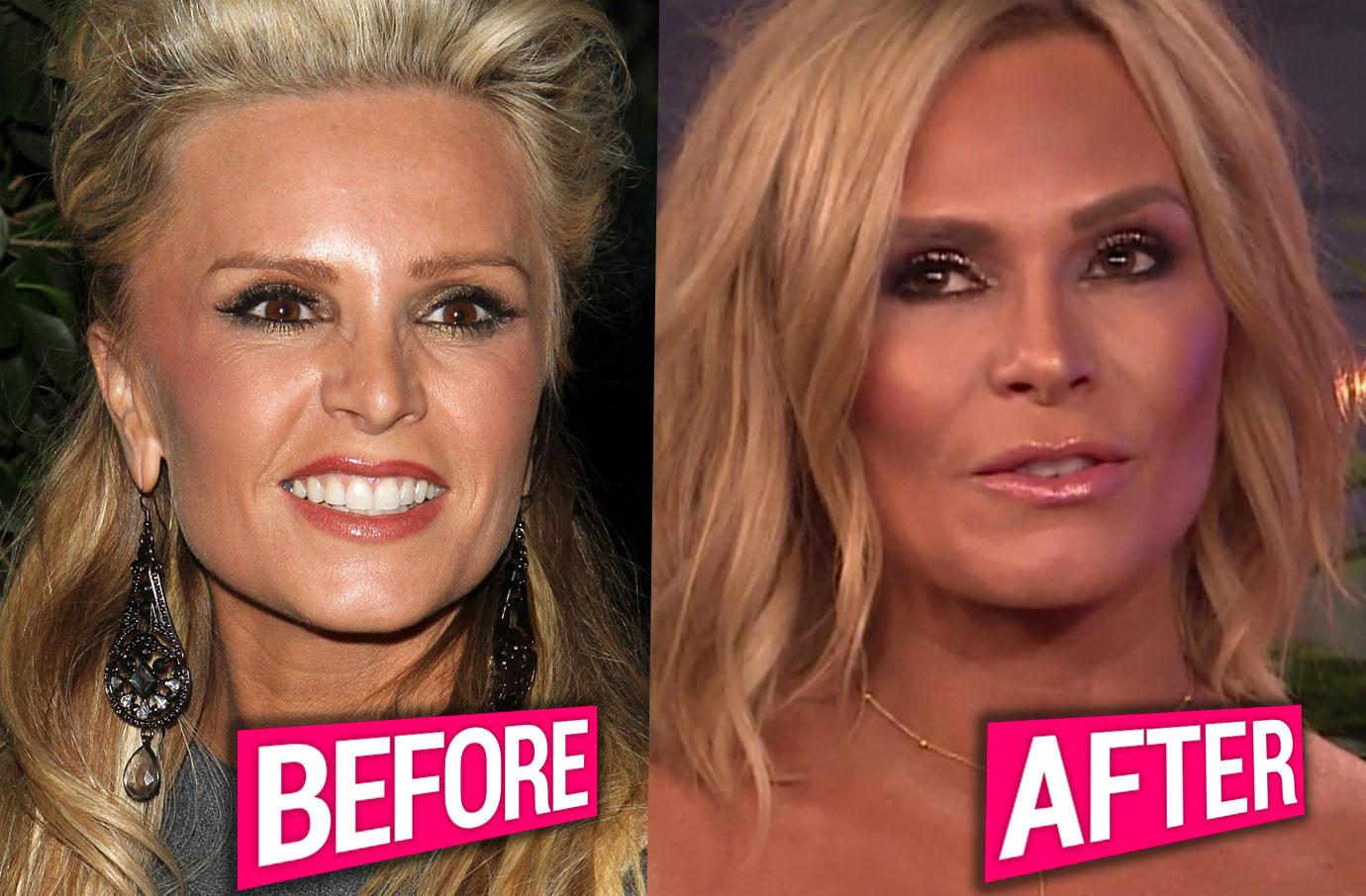 [PICS] Tamra Judge's Plastic Surgery Confession!