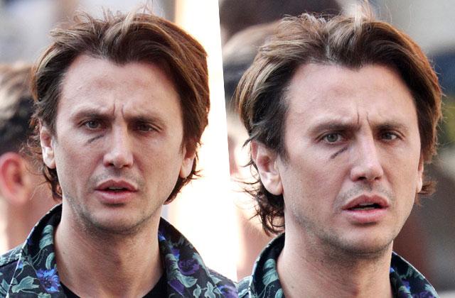 //jonathan cheban plastic surgery black eye pp