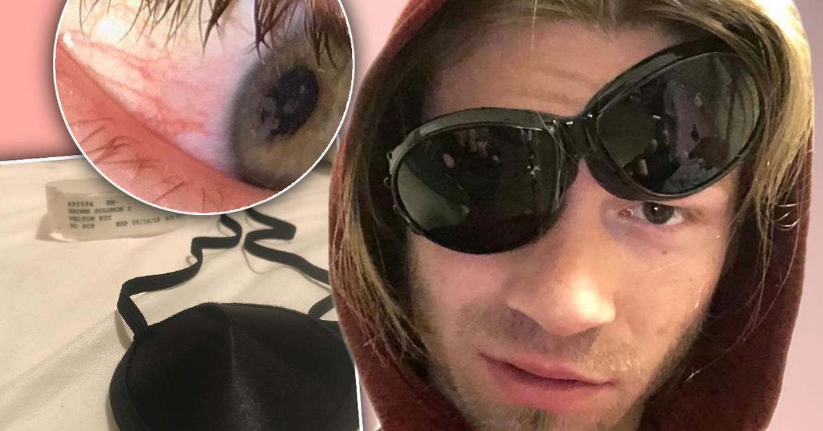 ‘Alaskan Bush People’ Star Bear Brown Eye Healing After Being Stabbed