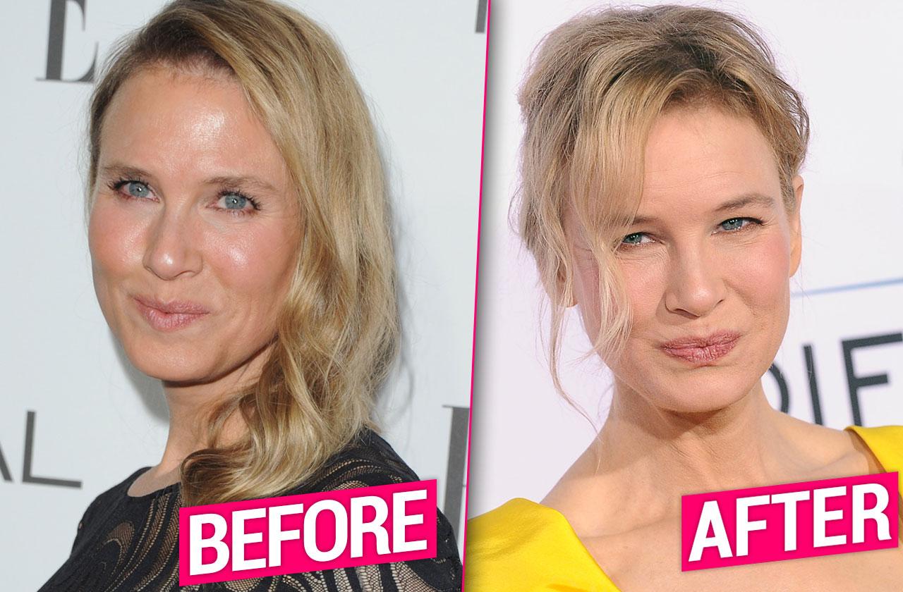 Renee Zellweger’s Possible Plastic Surgery Makeover Revealed Claim Top Docs