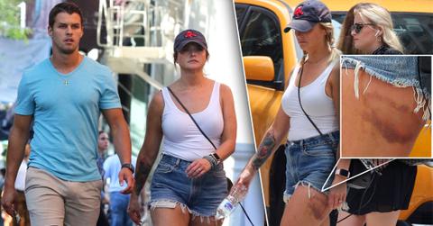 Miranda Lambert Shows Bruise In Shorts With Brendan McLoughlin