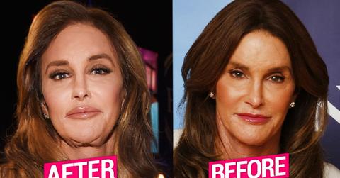 Caitlyn Jenner's Shocking Plastic Surgery Transformation Revealed By Top Doctors