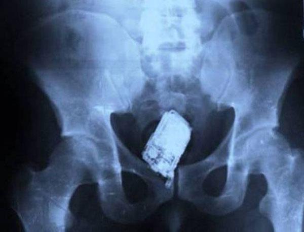 Inside Story Weird Objects And Horrifying Injuries Caught On X Ray 