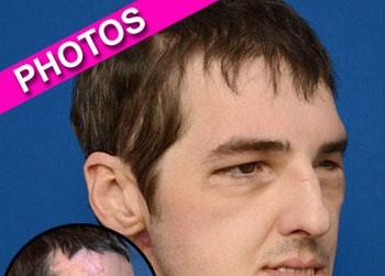 //richard norris face transplant