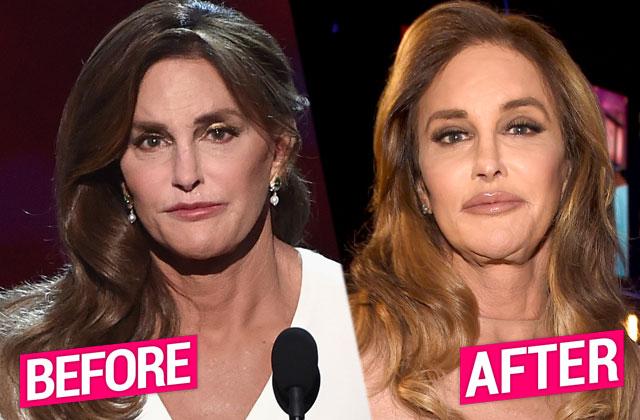 //caitlyn jenner plastic surgery lip fillers kylie jenner copycat