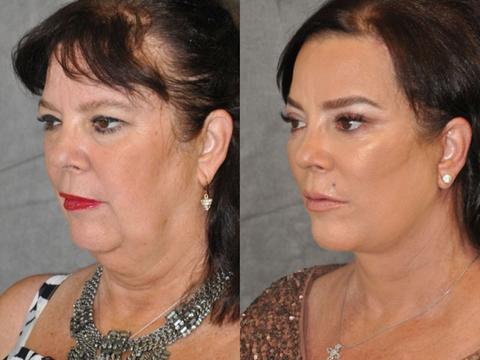 Just Like Kris! Jenner's Sister Goes Under The Knife To Look Like