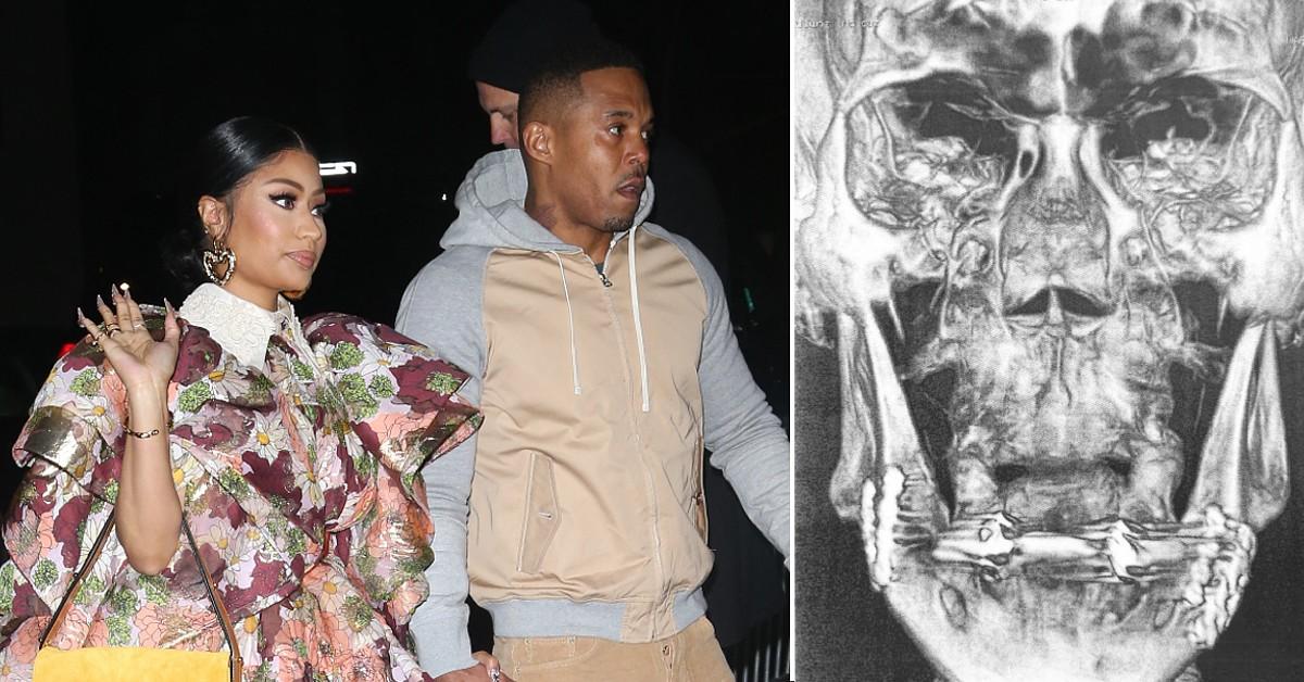 Man Suing Nicki Minaj's Husband Over Alleged Backstage Assault Submits Medical Records, X-ray of Broken Jaw in Court - Vimarsana News