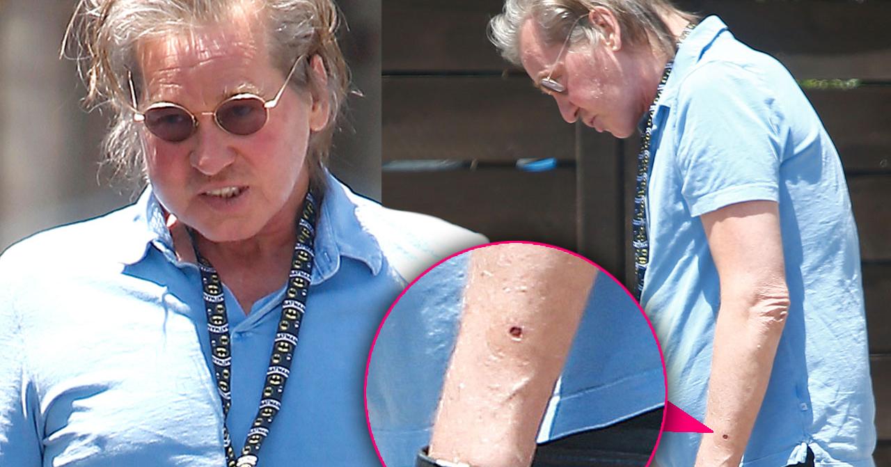 Val Kilmer Flesh Eating Cancer Scare
