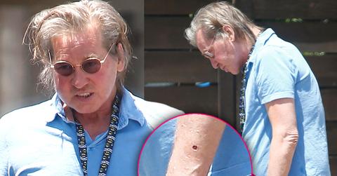 val kilmer flesh eating disease cancer hell horrifying photos