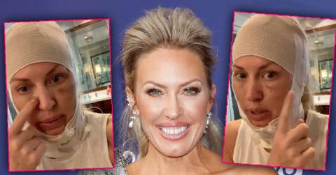 Braunwyn Windham Burke Gets Cosmetic Facial Work