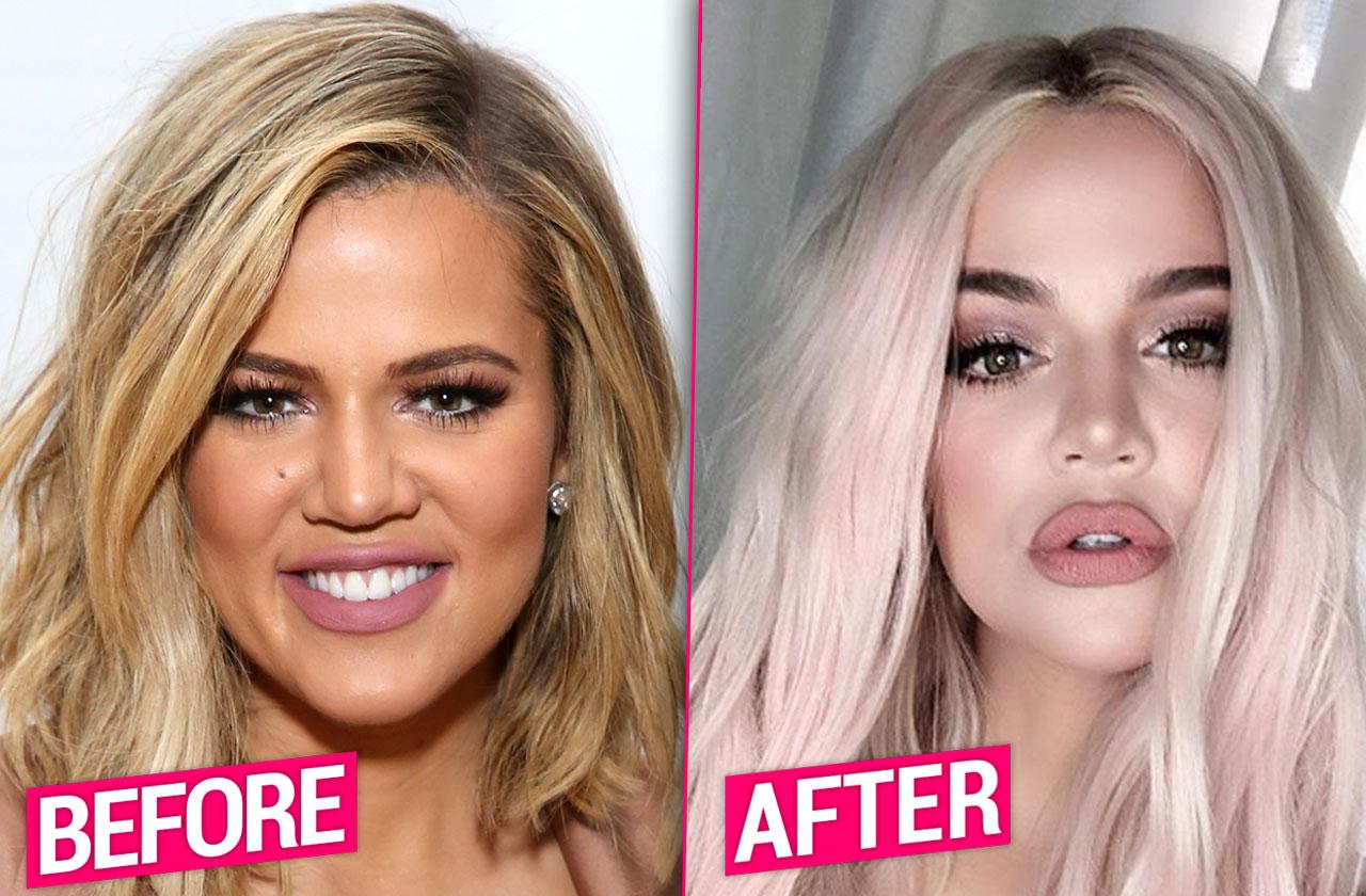Khloe Kardashian Plastic Surgery Face PP 