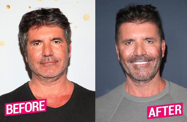 Simon-Cowell-Before-After-Plastic-Surgery-Photos-04.jpg