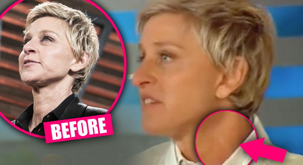 Plastic Surgery Secret? Top Docs Claim Ellen DeGeneres Had 'Facelift ...