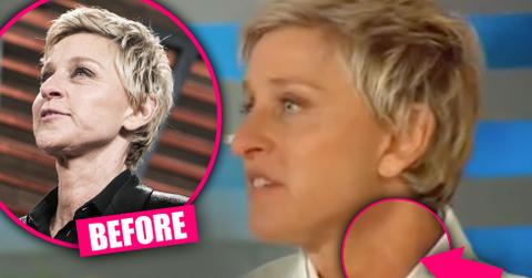 Ellen DeGeneres Plastic Surgery