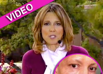 //hanna storm burned