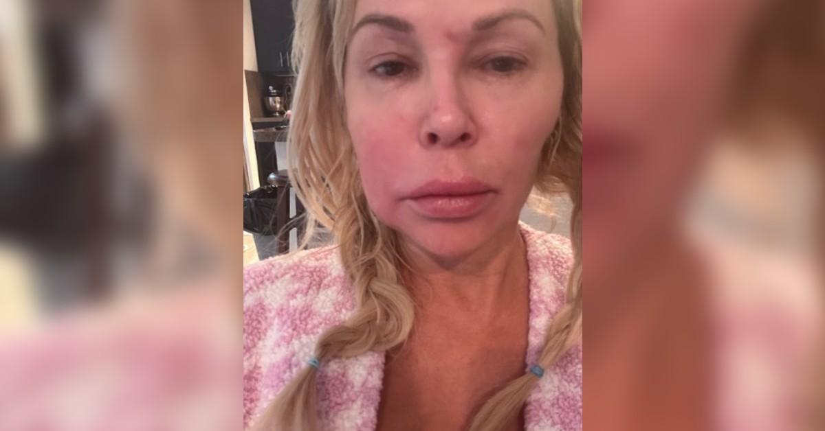 Brandi Glanville had 'lumps' on her face and neck and her hair was 'falling out.'