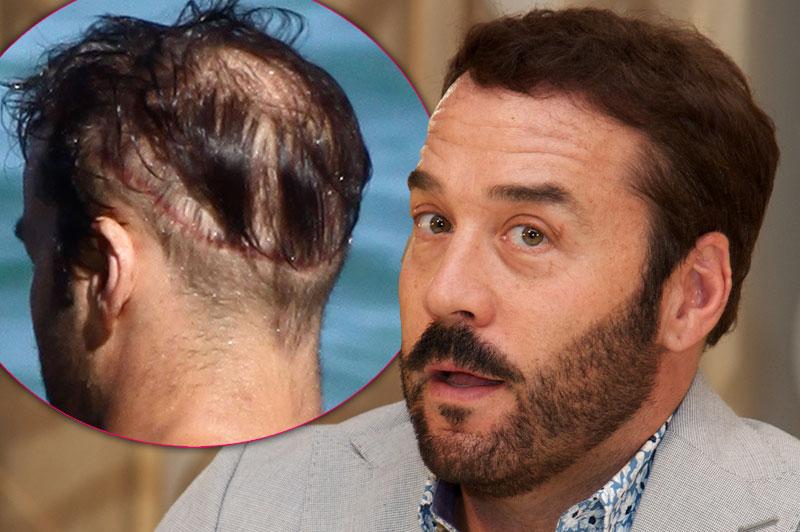 Celebrities Who Are Covering Up Their Bald Spots Receding Hairlines