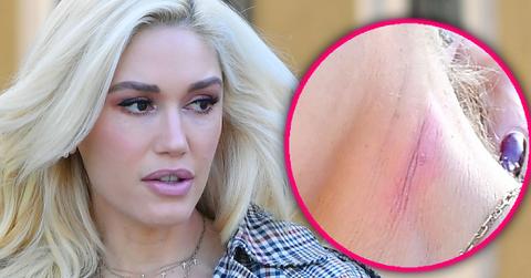 Gwen Stefani Has A Mystery Mark On Her Neck
