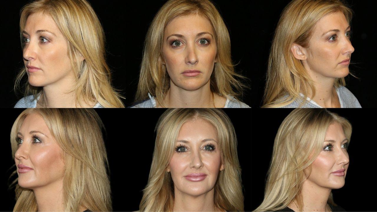 the ozempic face problem nobody warned you about and what surgeons are doing to fix it
