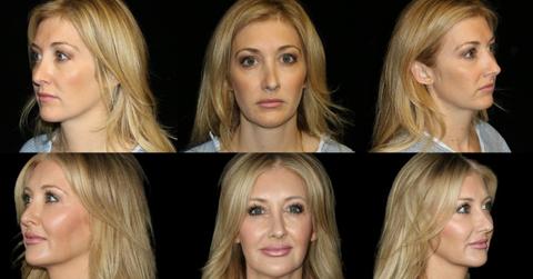 the ozempic face problem nobody warned you about and what surgeons are doing to fix it