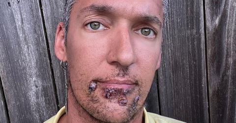 adult film star positive monkeypox photos symptomsjpg