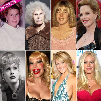 What Happened To Your Face The 10 Most Shocking Plastic Surgery Transformations